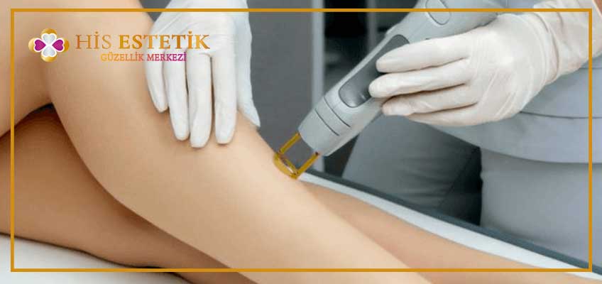 Bacak Lazer Epilasyon Fiyatları