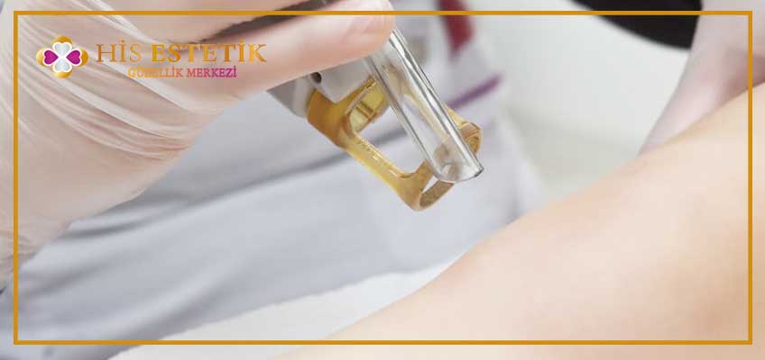 Alexandrite Lazer Epilasyon fiyatları