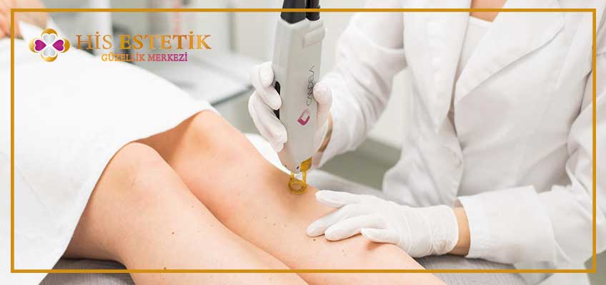 Alexandrite Lazer Epilasyon