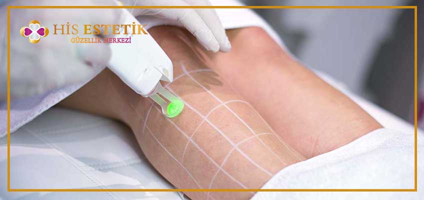 Alexandrite Lazer Epilasyon sonrası