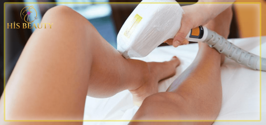 Diode Lazer Epilasyon